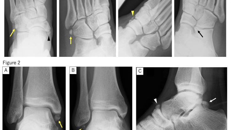 Figure 1. (A and B) Accessory navicular (black arrow head) and os peroneum (yellow arrow). (C) Os infranaviculare (yellow arrow head). (D) Os calcaneus secundarius (black arrow). Figure 2. (A) Os subtibiale (yellow arrow). (B) Os fibulare (yellow arrow head). (C)Os supranaviculare (white arrow head) and os trigonum (white arrow).