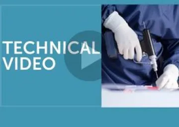 
Arthroscopic Lateral Patellar Facetectomy
