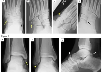 Figure 1. (A and B) Accessory navicular (black arrow head) and os peroneum (yellow arrow). (C) Os infranaviculare (yellow arrow head). (D) Os calcaneus secundarius (black arrow). Figure 2. (A) Os subtibiale (yellow arrow). (B) Os fibulare (yellow arrow head). (C)Os supranaviculare (white arrow head) and os trigonum (white arrow).