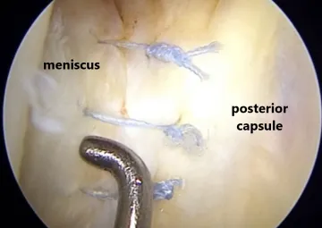 Image after the repair visualization through the high posteromedial portal and probe from the low posteromedial portal, the RAMP lesion is seen to be well approximated and stable.