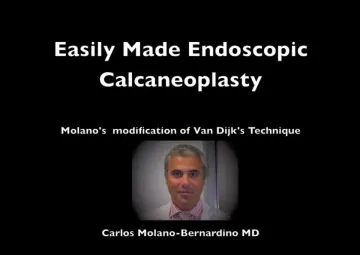 Calcaneoplasty Modification