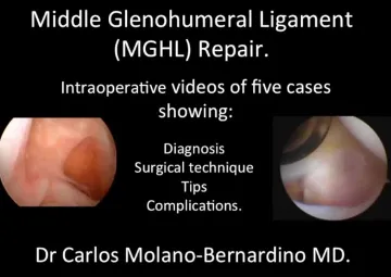 MIDDLE glenohumeral ligament repair