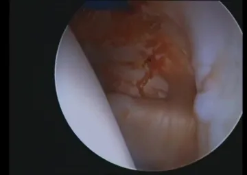 The 'Labral Bridge' - A Novel Technique for Arthroscopic Anatomic Knotless Bankart Repair