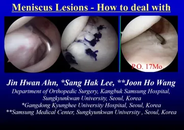 Meniscus lesions - How to deal with