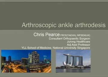 What's the advantage of arthroscopic ankle arthrodesis & which ones to pick?