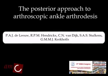 The posterior approach to arthroscopic ankle arthrodesis