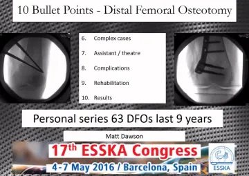 10 bullet points of distal femoral osteotomy