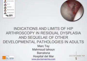 Indications and limits of hip arthroscopy in residual dysplasia and sequelae of other developmental pathologies in adults