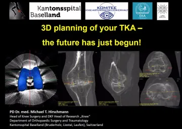 3D planning of your TKA - the future has just begun!