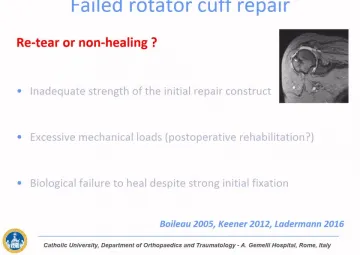 The role of biologic augmentation in revision rotator cuff repair