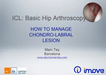 How to manage chondro-labral lesion