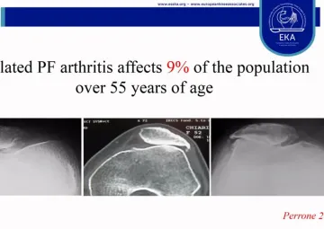 Treatment of isolated patellofemoral OA – patellofemoral versus total knee replacement