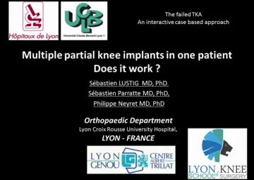 Multiple partial knee implants in one patient- does it work?