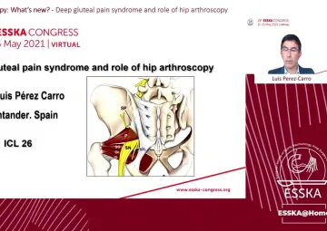 Deep gluteal pain syndrome and role of hip arthroscopy