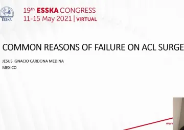 Common reasons for failure in ACL surgery