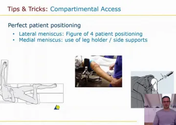 Meniscus transplantation: Tips and tricks