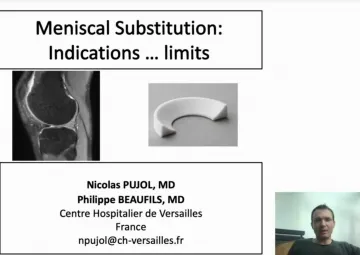 Indication and limitations of use of meniscal scaffolds