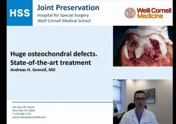 Huge osteochondral defects - State-of-the-art treatment