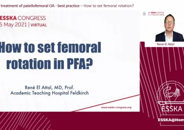 How to set femoral rotation?