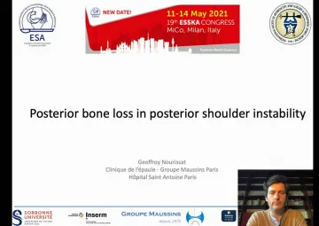 Posterior bone loss