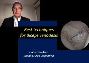 Best Techniques for Biceps Tenodesis