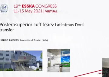 Posterosuperior cuff tears: Latissimus dorsi tranfer