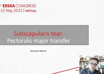 Subscapularis tear: Pectoralis major transfer