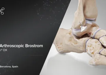 Arthrex - All-Inside Arthroscopic Brostrom with SwiveLock DX