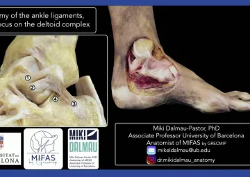 Anatomy of the ankle ligaments, with a focus on the deltoid complex