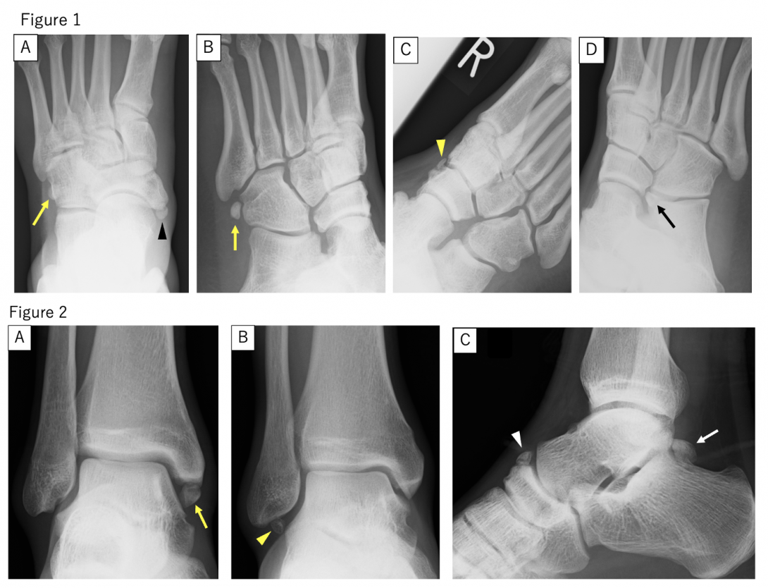 
MALE SOCCER PLAYERS HAVE A HIGHER INCIDENCE OF ACCESSORY OSSICLES
